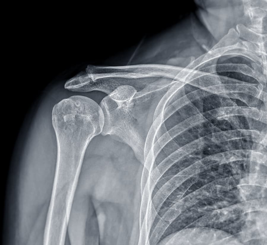 An X-Ray a shoulder condition | Second Look Orthopedics